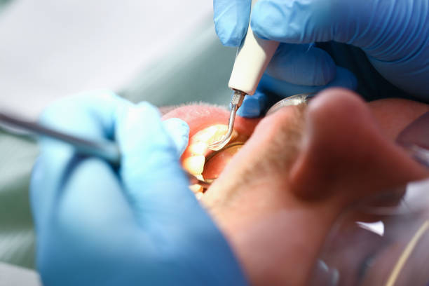 Best Urgent Care for Lost Fillings or Crowns in Lodi, CA